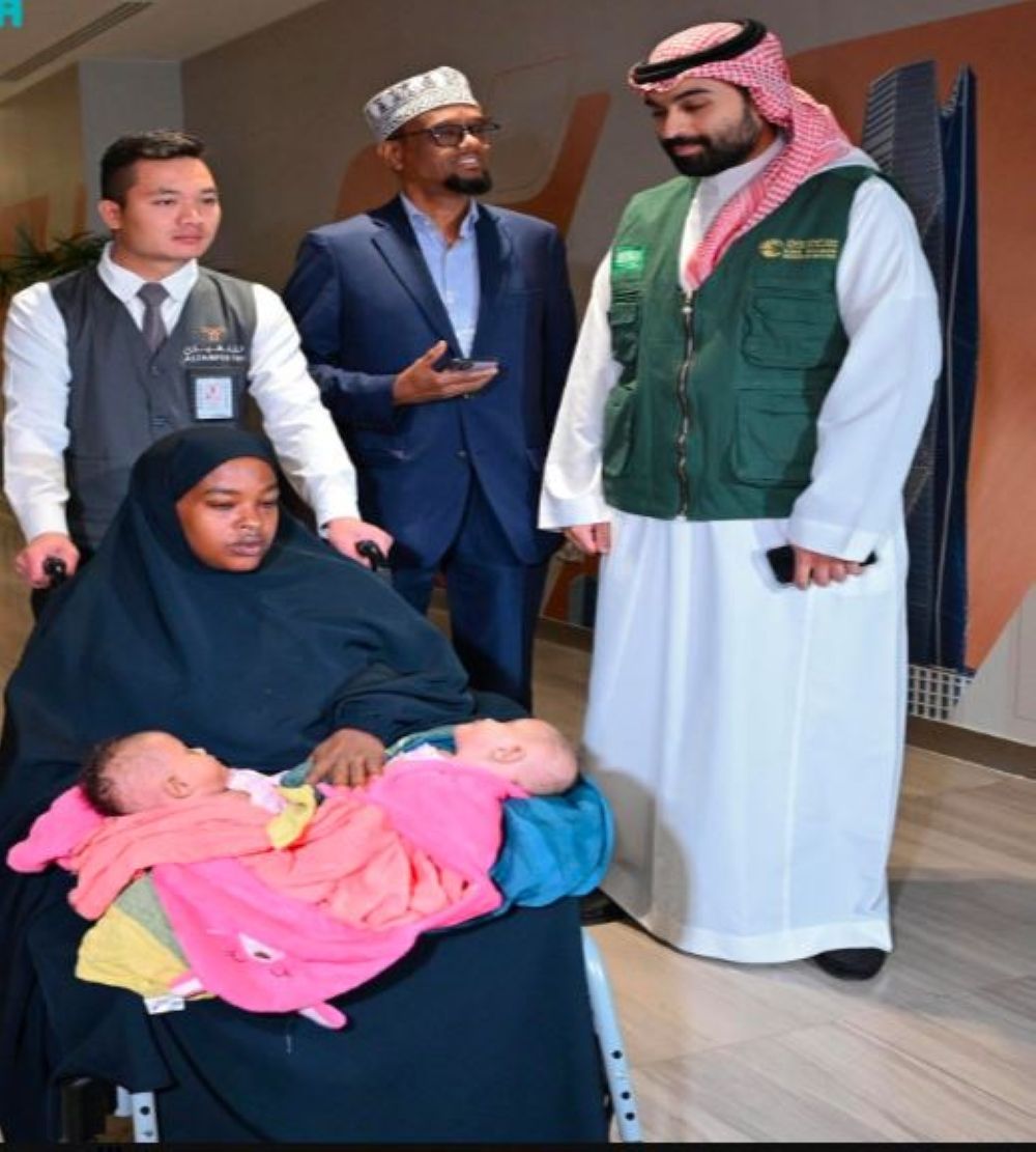 التوأم الملتصق الصومالي